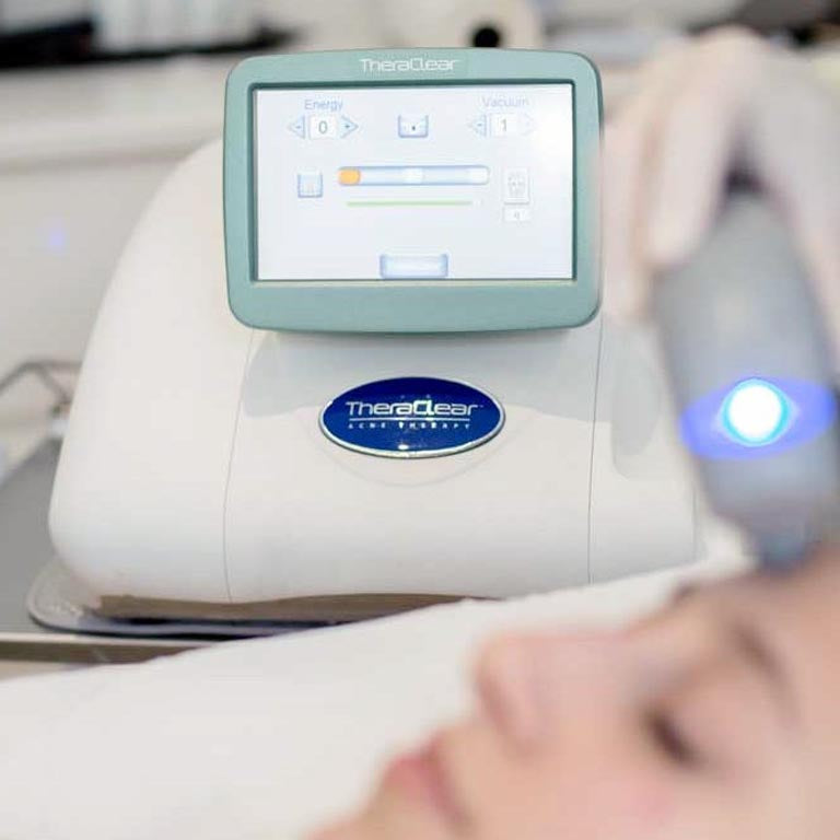 Two TheraClear Acne Laser Treatments