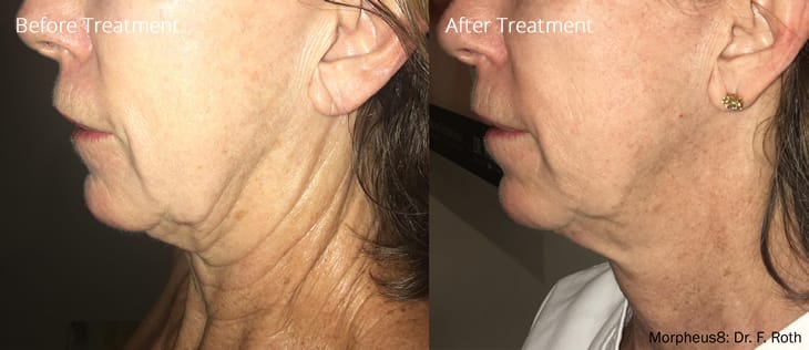 Morpheus8 Microneedling Fractional Treatment Neck / Package prices available