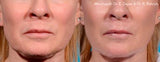 Morpheus8 Microneedling Fractional Treatment Face / Package prices available