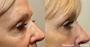 Morpheus8 Microneedling Fractional Treatment Face / Package prices available